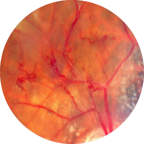 Диабетическая ретинопатия: препролиферативная форма