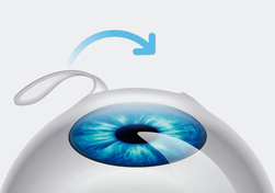 Операция на глаза близорукость ярославль